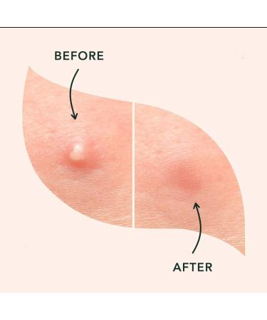 ACNE Patches - Miracle Hydrocolloid Spot Treatment for Blemishes & Breakouts | GO Acne GO - Fast Shipping Worldwide - Buy Online on GoSupps.com
