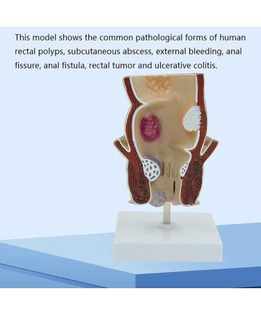 Human Rectal Hemorrhoid Lesions ical Model Colon Anal Sphincter Anorectal Teaching Specimen - Buy Online on GoSupps.com