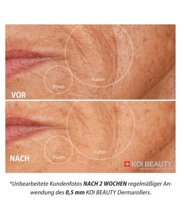 Koi Beauty Dermaroller 200 Real Needles - Microneedling Tool for Beard & Hair Growth | 0.5mm Needle Roller for Men & Women - Buy Online on GoSupps.com