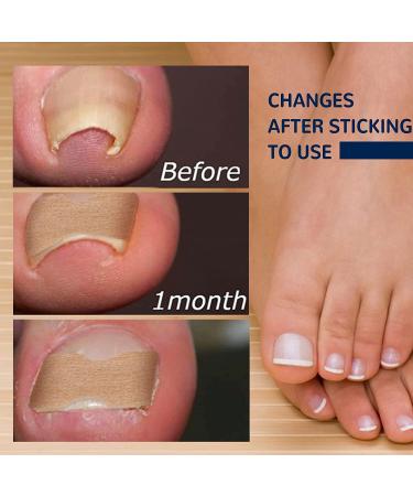 Toenail Correction Patch 100PCS - Professional Ingrown Toenail Corrector Strips for Foot Care - Health Toenail Treatment Tool for Glue-Free Nail Correction - Blue - Buy Online on GoSupps.com