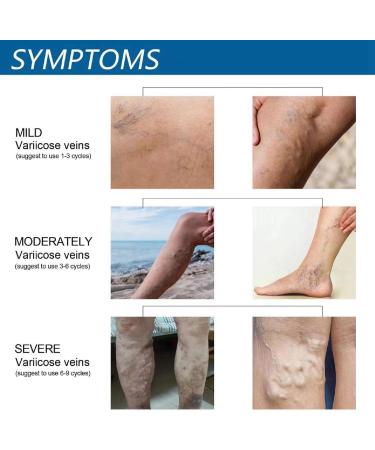 Varicose Veins Cream - Spider Veins Repair & Treatment for Legs | Relief Ointment - Buy Online on GoSupps.com