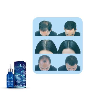 Coradoma Blue Hair Serum - Anti-Hair Loss & Growth Serum for Men & Women | Natural Hair Growth Oil - Buy Online on GoSupps.com