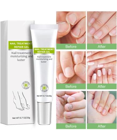 Nail Repair Treatment Gel - Instantly Renew Yellow, Cracked Nails - Buy Online on GoSupps.com