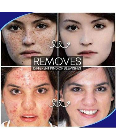 Removal Mark Pimple Pro Blemish Scar Spots Ointment for Glass Skin - White One Size - Buy Online on GoSupps.com