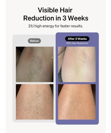 Ulike Air 3 IPL Hair Removal: Painless & Long-Lasting Results for Women and Men - Body & Face Hair Removal with Sapphire Ice-Cooling System - Buy Online on GoSupps.com