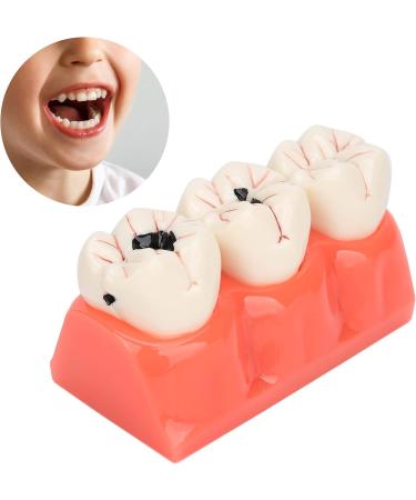 Verdant Touch Simulation Teeth Caries Model - Removable Tooth Caries Demonstration for Dental Education | International Shipping - Buy Online on GoSupps.com