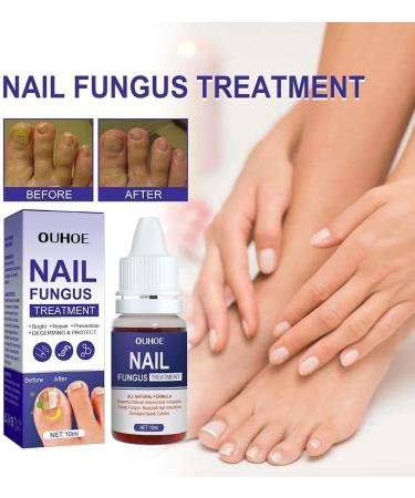 ZERZK 10ml Repair Nail Fungus Treatments Essence Foot Care Nails AntiInfection Toe Fungus Serum Onychomycosis Removal Gel - Buy Online on GoSupps.com