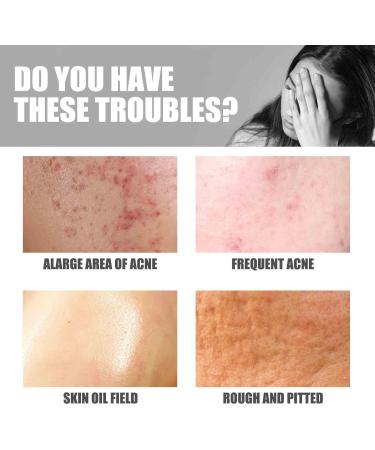  Orgrul Cream for treating buttock acne and pimples anti-pimple cream deep pore cleansing balances skin's moisture and oil gentle ingredients easy to apply - Buy Online on GoSupps.com