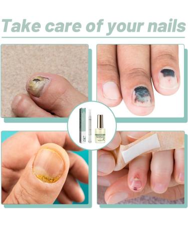 2 pi ces Stylo de Soin des Ongles+vernis poderm mycose ongle pied Traitement Mycose Ongle des Pied Puissant R paration Des Ongles Renforce et Revitalise Les Ongles Huile De Th ier et Romarin - Buy Online on GoSupps.com