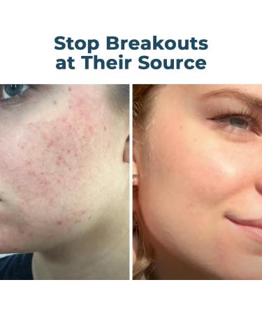 VitaMedica Clear Skin Bundle | Natural Nutraceutical & Probiotic Cleanser & Moisturizer for Breakout-Prone Skin - Shop Internationally - Buy Online on GoSupps.com