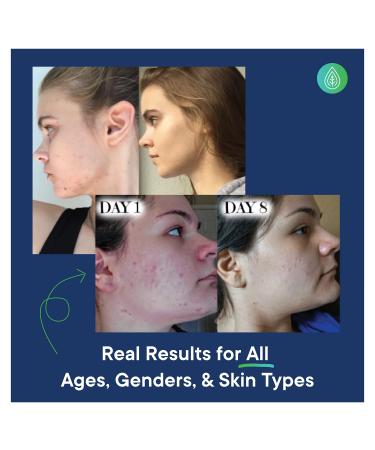 OrganiClear Acne Treatment System Kit - Benzoyl Peroxide Cream, Salicylic Acid Face Wash, Soothing Lotion - 90-Day Complete Skin Care Set - Buy Online on GoSupps.com