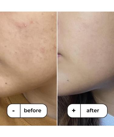 Buy Mangostin Plus Breakout Gel - Gentle Non-Drying Treatment for Sensitive Blemish-Prone Skin - 0.5 FL OZ - International Shipping Available - Buy Online on GoSupps.com