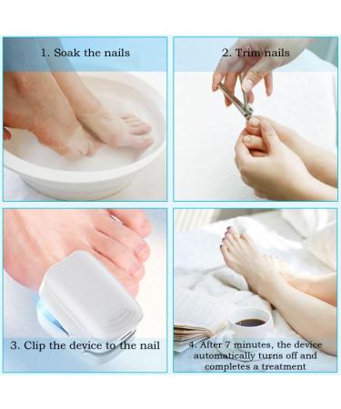 Nail Fungus Laser Treatment Device - Effective Home Therapy for Damaged Nails - 910nm Infrared & 470nm Blue Light - Buy Online on GoSupps.com