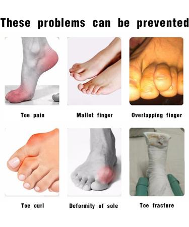 Buy Eodkse Toe Rail - Hammer Toe Smoothing & Support for Curved Broken Toes | International Shipping Available - Buy Online on GoSupps.com