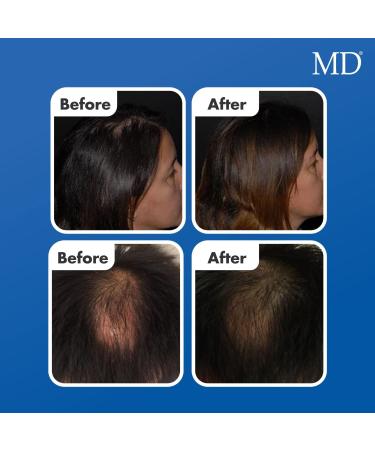 MD Factor Natural Hair Growth Serum | Prevent Thinning Hair & Boost Follicle Energizer for Thicker Hair - 30-Day Supply - Buy Online on GoSupps.com