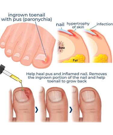 German Toenailcare Paronychia & Bunion Relief Oil for Thick, Discolored Nails - 1Pcs - Buy Online on GoSupps.com