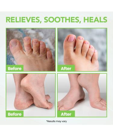 Extra Strength Athlete's Foot Balm - Advanced Treatment Cream for Cracked Heels & Itchy Skin | Effective Foot Care for Men & Women - Buy Online on GoSupps.com