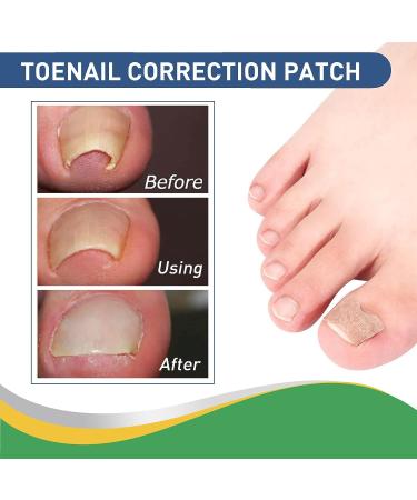 Fitmedify Nail Patches - Toenail Correction Tool for Ingrown Nails, Fungus Relief (50Pcs) - Buy Online on GoSupps.com