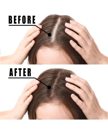 VOTALA Hair Growth Serum | Anti Hair Loss Treatment for Men & Women | Promotes Thicker & Stronger Hair with Regrowth Benefits - Buy Online on GoSupps.com