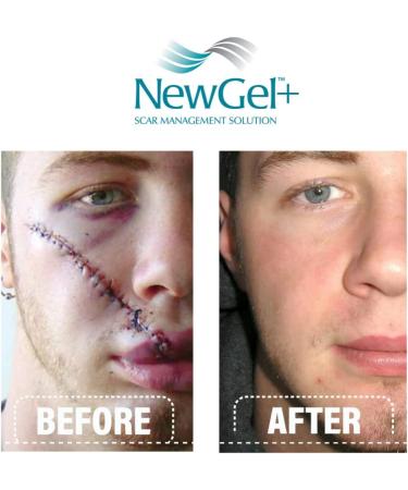 NewGel+E Advanced Silicone Scar Treatment Gel - 15g for Old & New Scars, Surgery, Injury, Keloids, Burns, Acne - With Vitamin E - Buy Online on GoSupps.com