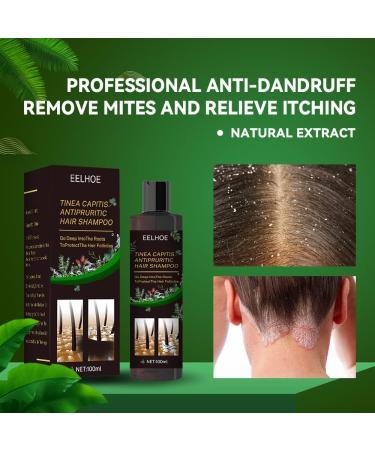 Eczema Psoriasis Anti Dandruff Shampoo for Soothing Dry, Itchy Scalp (200ml) - Buy Online on GoSupps.com