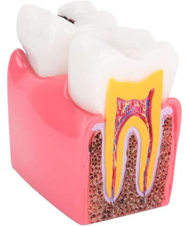 Buy Caries Comparison Study Models | Dental Anatomy Teeth Models for Dentist Education - International Shipping - Buy Online on GoSupps.com