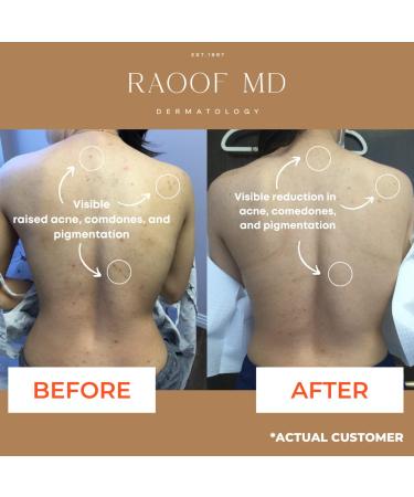RAOOF MD Acne Brightening Pads - 5% Glycolic Acid & 2% Salicylic Acid Pads for Face & Body - 60 Count - Buy Online on GoSupps.com