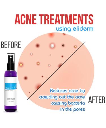 Topical Probiotic Spray for Skin - 13 Live Strains | Skin Care for Acne, Folliculitis, Dermatitis, Rosacea, Eczema | Body & Face Mist Deodorant - Buy Online on GoSupps.com