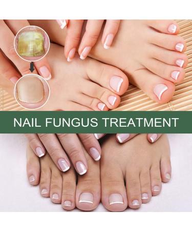 Antifungal Nail Treatment for Damaged Nails - Toe Care Solution for Renewing Discolored Feet - Buy Online on GoSupps.com