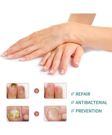 Nail Fungal Treatment Extra Strong Nail Fungus Treatment for Toenail and Fingernail Fingernail Toenail Care Fix Renew Damaged Broken Anti Fungus Nail Repair(20ml) - Buy Online on GoSupps.com