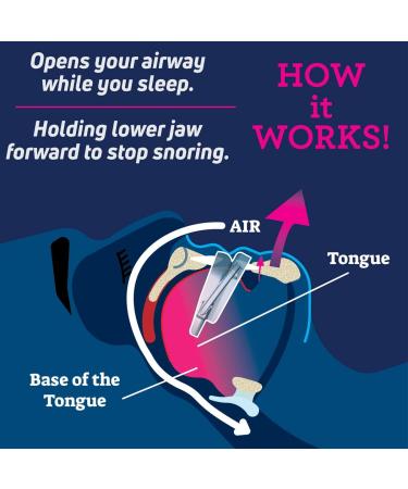 SmartGuard Anti-Snore Device: Customizable Snore Reducing Mouthpiece for Men and Women | Comfortable and Adjustable Oral Appliance to Open Airway - Buy Online on GoSupps.com