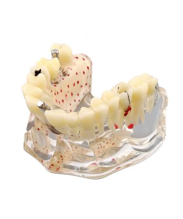 Dental Upper Implantate Model - Upper Overdenture Restoration Model - With superior teeth demo transparent vision soft gum implant nail for education and study model (b)