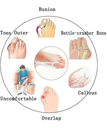 Buy Pedimend Silicone Gel Toe Separator | Hammer Toe & Ball Protection | Improve Balance & Foot Power | Re-align Curved Toes | International Shipping - Buy Online on GoSupps.com