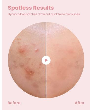 Glam Up Hydrocolloid Acne Patches (108 Counts) - Invisible Ultra Thin Spot Cover Absorbing Pimple Facial Stickers for Zit and Blemishes 2 Sizes 10mm & 12mm - Buy Online on GoSupps.com