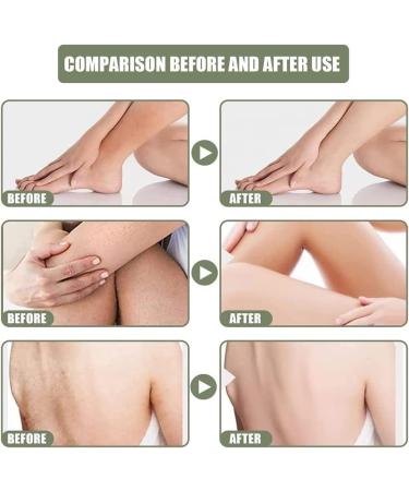 Kwiphiny 3PCS Flysmus Keratosistreat Deep Clean Smooth Cream for Rough and Bumpy Dry Skin - Buy Online on GoSupps.com