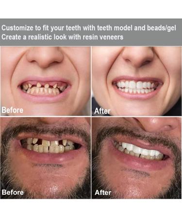 Tooth Repair Kit: Temporary Fix for Missing, Chipped, Broken Teeth - Thermal Beads & Brace Mold Included - Buy Online on GoSupps.com