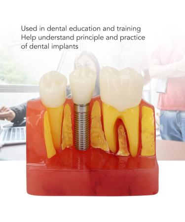 Verdant Touch Crown Bridge Demonstration Model - 4X Dental Implant Model for Doctor-Patient Education | International Shipping - Buy Online on GoSupps.com