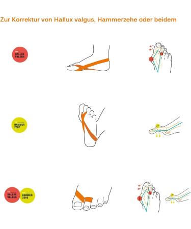 Compressana Tape Loops for Hallux Valgus & Hammer Toe Silicone-Free Toe Spreaders - Size 33-34 Color Diamond I - 1 Pair International Shipping Available - Buy Online on GoSupps.com