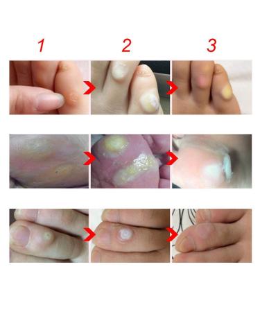 Foot Corn Plaster - Callus & Corn Removal Cream for Pain Relief - 10ml - Buy Online on GoSupps.com