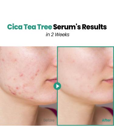 GLAM UP CICA Double Shot | Acne Treatment Serum with Hyaluron BHA Centella Asiatica & Tea Tree Oil for Sensitive Skin - 30ml - Buy Online on GoSupps.com
