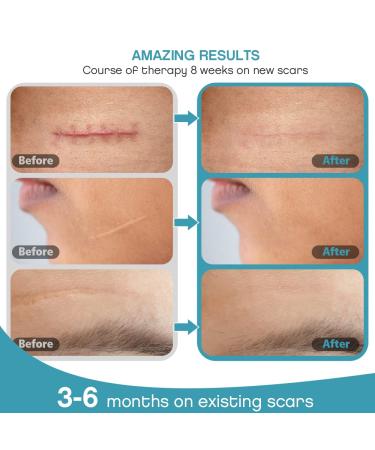Silicone Scar Strips 1.6''x6'' - 4 pcs Multi-Use Scar Removal Cream (2 Month Supply) - Reusable Scar Tape - Flesh Color - Buy Online on GoSupps.com