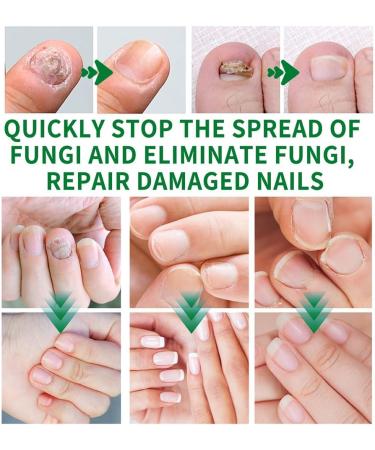dizhenhui104jiaju LYEAA Nail fungus treatment 7 days nail fungus treatment toenails cuticle care oil ginger nail serum nail strengthening oil for damaged nails 1 piece - Buy Online on GoSupps.com