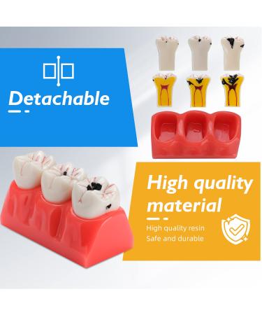Buy Dental Caries Teeth Model - 4X Removable Tooth Decay & Pathology Display | International Shipping - Buy Online on GoSupps.com