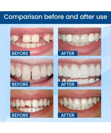 NHPY 2 stuks Reparatie Teeth Dental Pearl Temporary Filling for Broken Vouwantes Teeth Dental Filling Material 30 ml - Buy Online on GoSupps.com