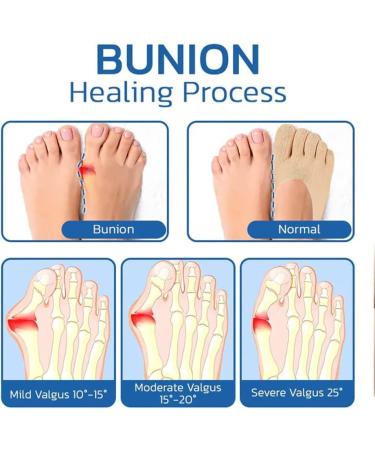 Sofeet Bunion Relief Socks - Anti-Bunions Health Orthoes, Pink Toe Alignment Socks (Pack of 5) - Buy Online on GoSupps.com