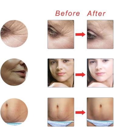 Titanium Micro Needle Derma Roller for Face and Body Care Help Men Beard Growth Reduce - Buy Online on GoSupps.com