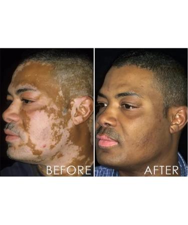 DASHENRAN Vitiligo Removal Relief Spray - White Spot Treatment & Skin Repair (3 pcs) - Buy Online on GoSupps.com