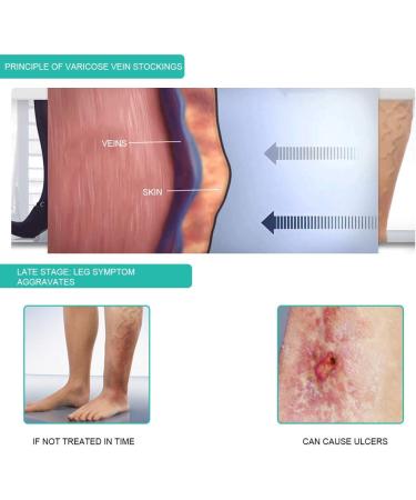 Yinhing Compression Stockings Unisex Thigh High Pain Relief & Leg Care Reduce Leg Pain 1 Pair - Buy Online on GoSupps.com