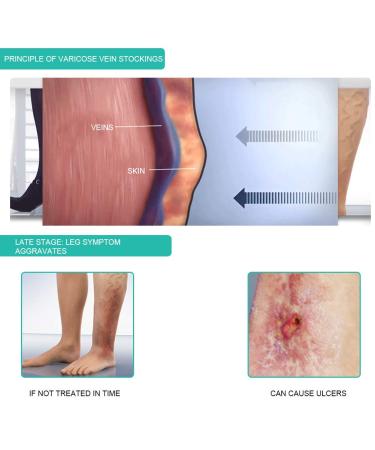 Knihohe Compression Stockings - Thigh-High Varicose Veins Socks for Men & Women | Open Toe Calf Protection & Opaque Knee-High Sleeves - Buy Online on GoSupps.com