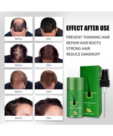 Hair Growth Serum - Anti-Hair Loss Treatment for Thinner Hair | Thickening & Re-Growing Solution (1 PC) - Buy Online on GoSupps.com
